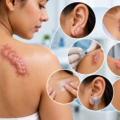 Keloid Scars: Why They Keep Growing Back, and What Actually Controls Them