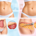 Tummy Tuck or Liposuction: Which One Does Your Abdomen Actually Need?