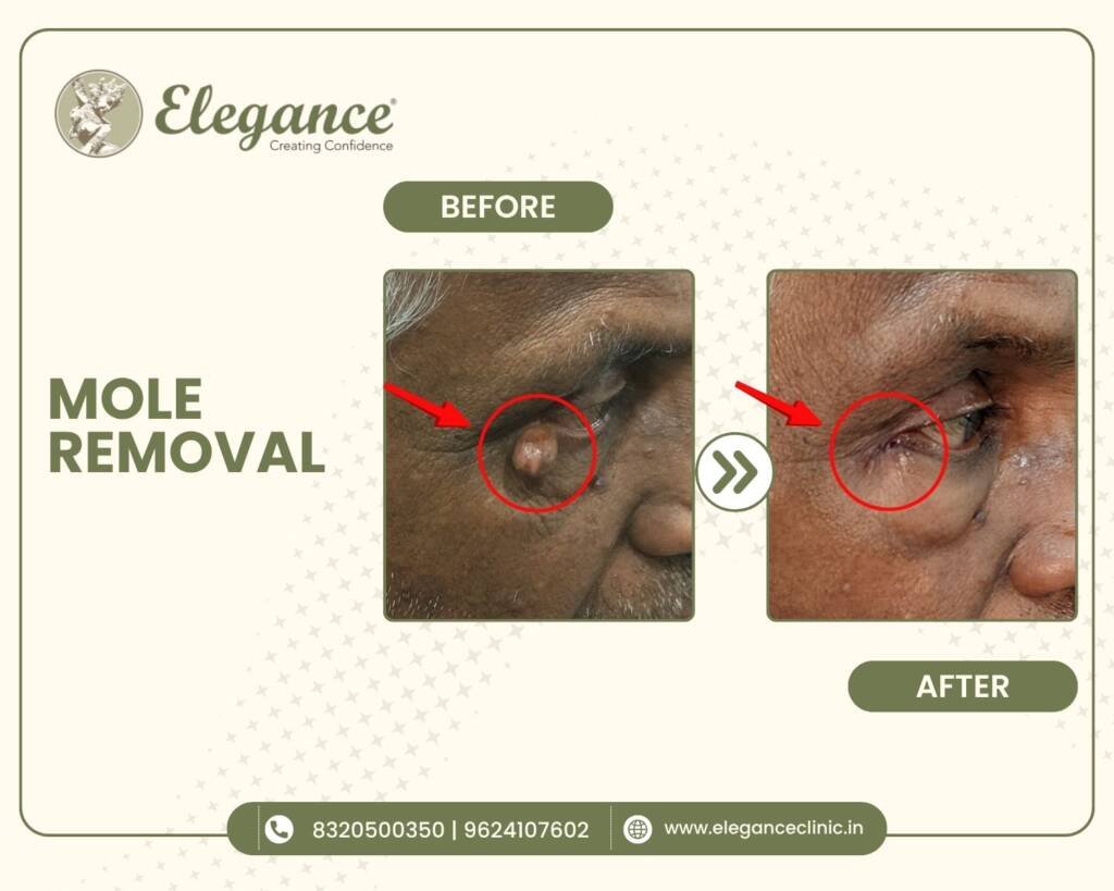 mole-removal