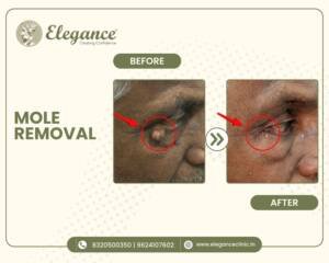 mole-removal