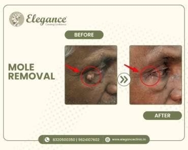mole-removal