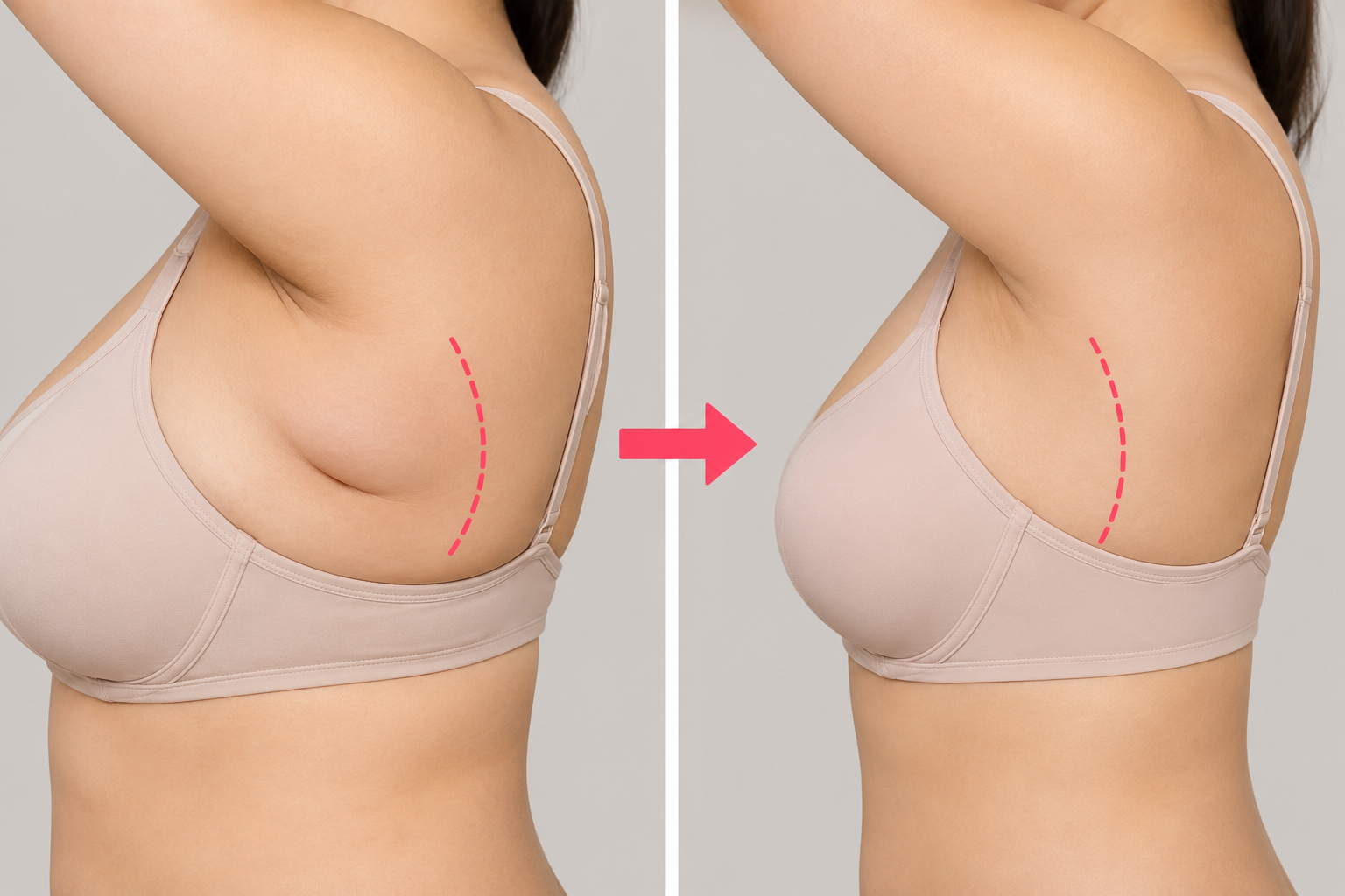 axillary breast fat removal