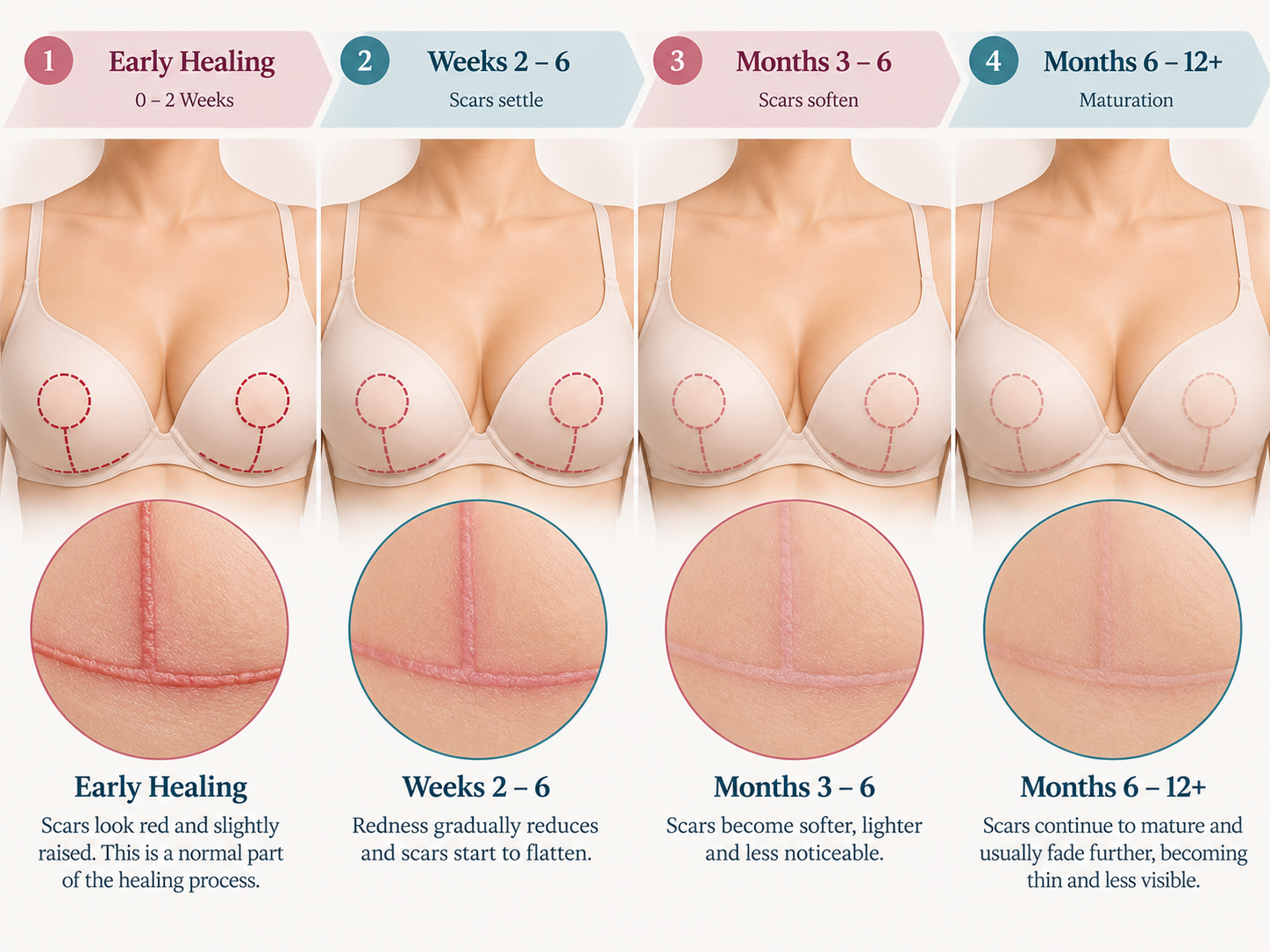 breast lift scars