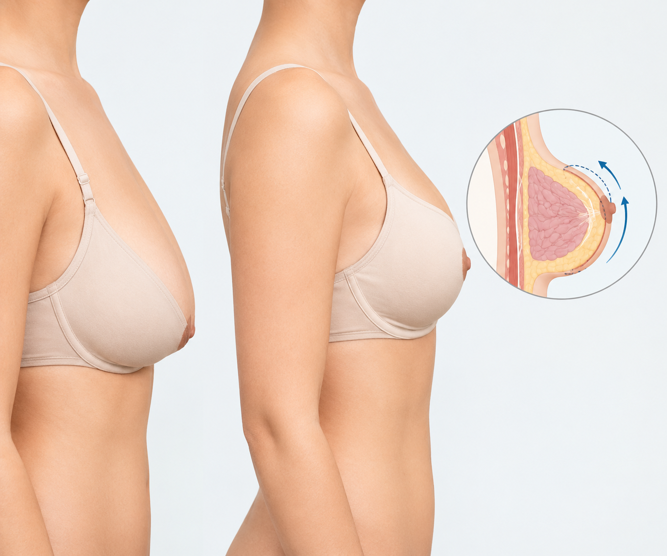 breast lift without implants