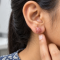 Keloid After Ear Piercing: Can It Be Removed, and Can You Wear Earrings Again?