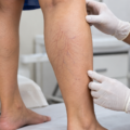 Spider Veins on the Legs: Injections or Laser, How Many Sessions and What to Expect