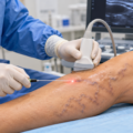 Varicose Veins: Laser, Radiofrequency, Glue, Foam or Surgery? How the Right Method Is Chosen